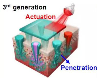 第三代：通过微针介导的皮肤层破坏和微针伴随的各种功能增强药物转运.jpg